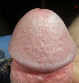 Foto zväčšeného penisu žaluďa