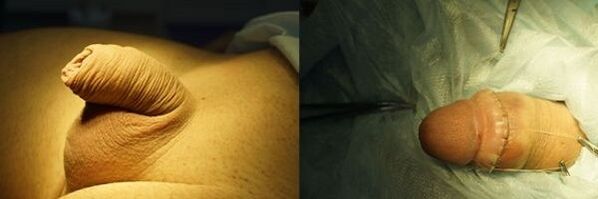 penis pred a po operácii zväčšenia