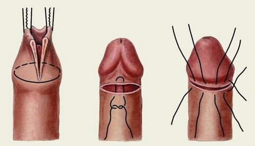 podstata operácie na zväčšenie penisu