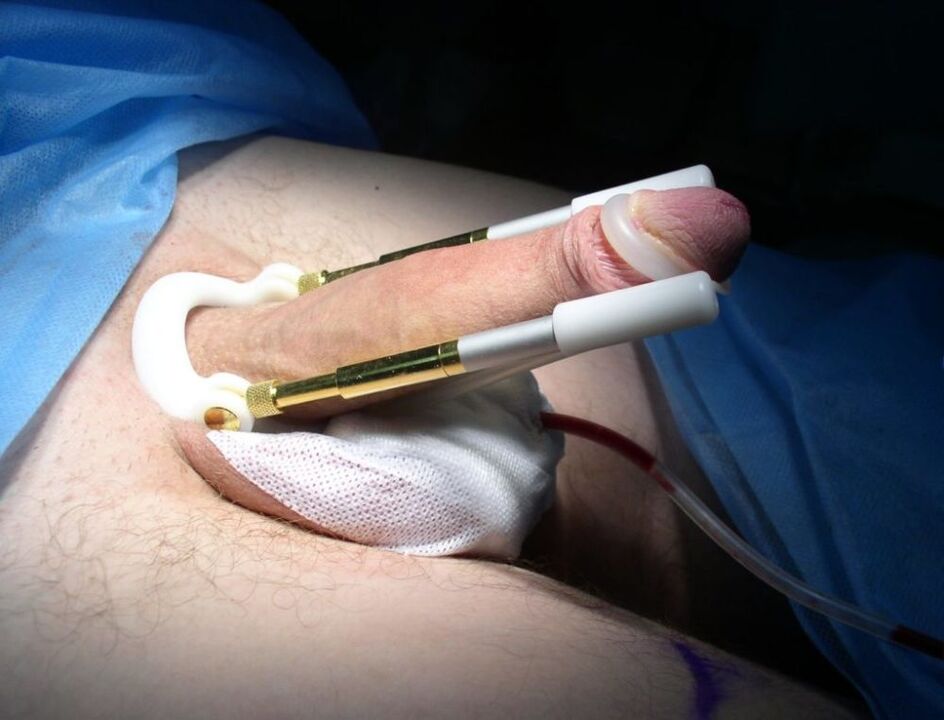 predlžovač po chirurgickom zákroku na zväčšenie penisu