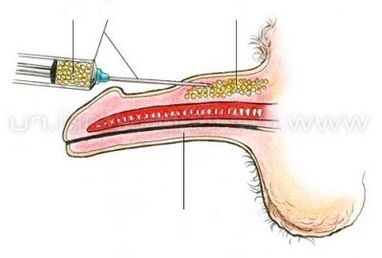 injekčné zväčšenie penisu